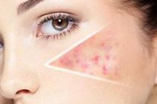 激光祛痘注意事項