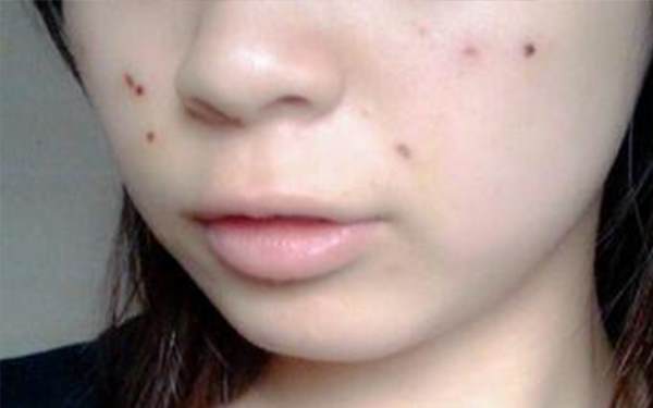 激光點痣后效果好不好？會不會留疤？