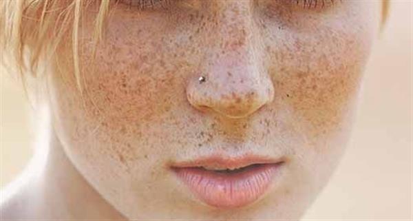 激光<a href=http://www.f3bb6.cn/listinfo-795-0.html target=_blank class=infotextkey>祛斑</a>后怎么護理好