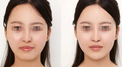 小分子打下巴有效果嗎