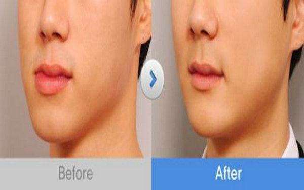 下額角整形多少錢