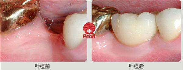 廣州種植牙哪家好