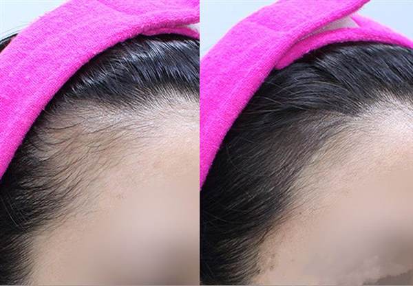 發際線調整手術價格