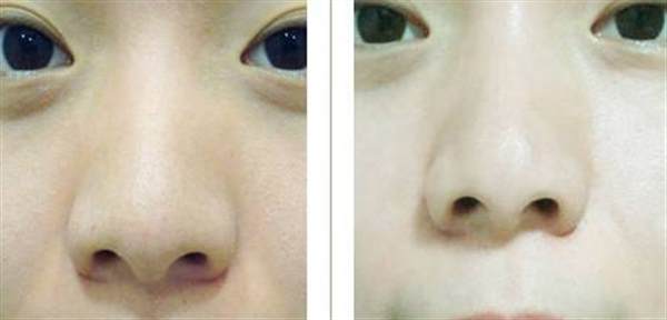 彩光<a href=http://www.f3bb6.cn/listinfo-770-0.html target=_blank class=infotextkey>嫩膚</a>的治療過程是怎么樣的