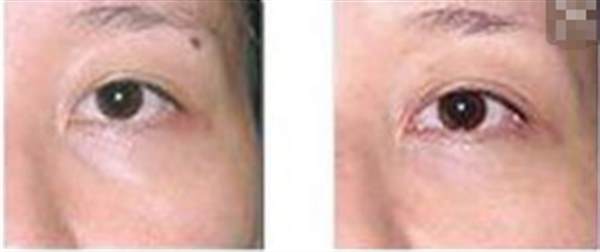 貴陽<a href=http://www.f3bb6.cn/listinfo-767-0.html target=_blank class=infotextkey>祛痣</a>多少錢