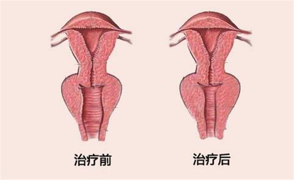 縮陰手術的價格