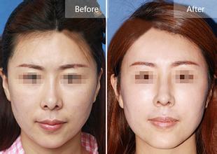 假體<a href=http://www.f3bb6.cn/listinfo-737-0.html target=_blank class=infotextkey>隆鼻</a>半個月恢復圖