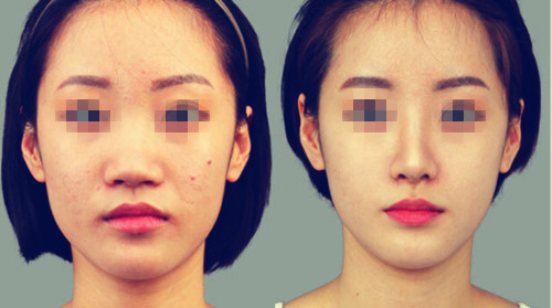 自體脂肪<a href=http://www.f3bb6.cn/listinfo-737-0.html target=_blank class=infotextkey>隆鼻</a>壞處