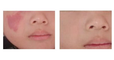 激光<a href=http://www.f3bb6.cn/listinfo-773-0.html target=_blank class=infotextkey>去胎記</a>多錢一次