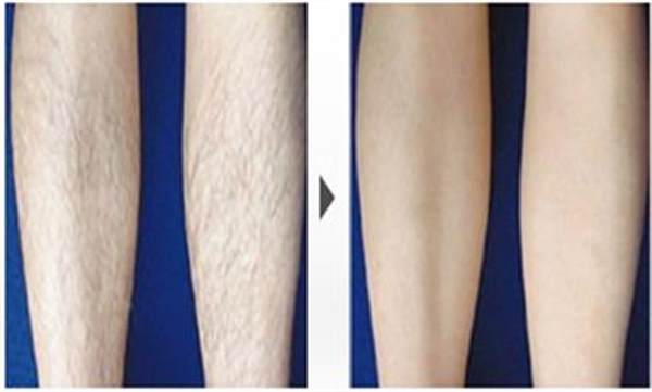 冰點(diǎn)長期<a href=http://www.f3bb6.cn/listinfo-670-0.html target=_blank class=infotextkey>脫毛</a>真的能長期嗎