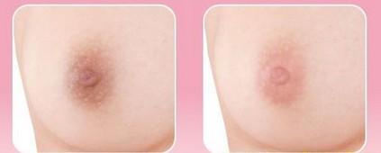 <a href=http://www.f3bb6.cn/listinfo-616-0.html target=_blank class=infotextkey>乳暈整形</a>的適應癥有哪些