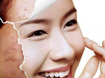 激光祛痘效果怎么樣