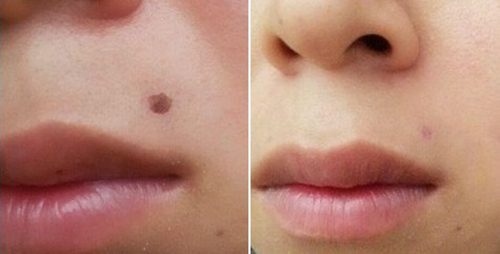 怎么<a href=http://www.f3bb6.cn/listinfo-767-0.html target=_blank class=infotextkey>祛痣</a>較好的方法