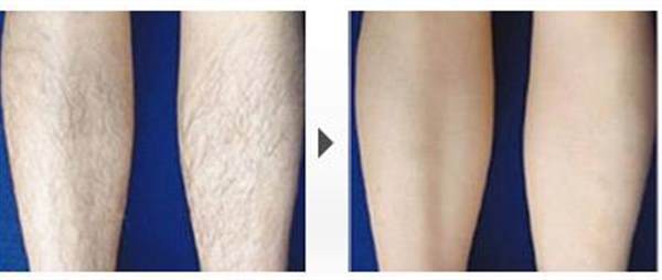 光子<a href=http://www.f3bb6.cn/listinfo-670-0.html target=_blank class=infotextkey>脫毛</a>會不會疼