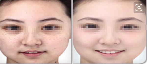 什么樣的皮膚問題適合做光子<a href=http://www.f3bb6.cn/listinfo-770-0.html target=_blank class=infotextkey>嫩膚</a>