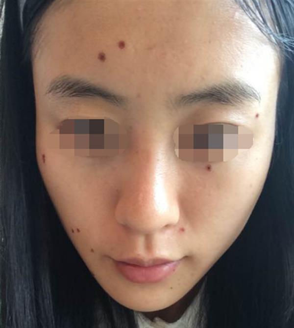 去正規(guī)醫(yī)院點(diǎn)痣多少錢