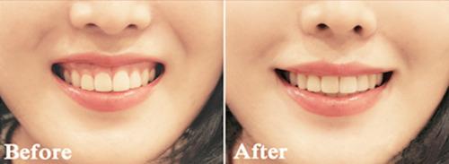 <a href=http://www.f3bb6.cn/listinfo-632-0.html target=_blank class=infotextkey>正頜</a>手術(shù)風(fēng)險大嗎