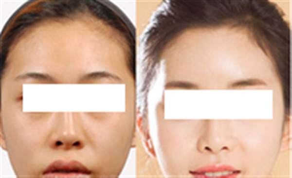 盤點光子<a href=http://www.f3bb6.cn/listinfo-770-0.html target=_blank class=infotextkey>嫩膚</a>的危害性