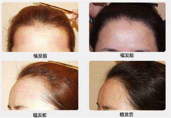 植發手術安全嗎
