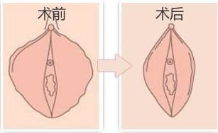 做私密能激光堅(jiān)持多久