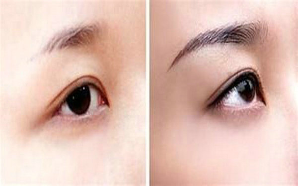 <a href=http://www.f3bb6.cn/listinfo-655-0.html target=_blank class=infotextkey>切眉</a>手術需要多少錢?