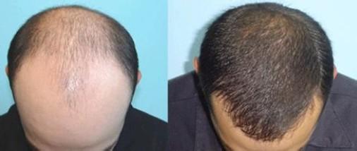 禿頂植發(fā)多少錢