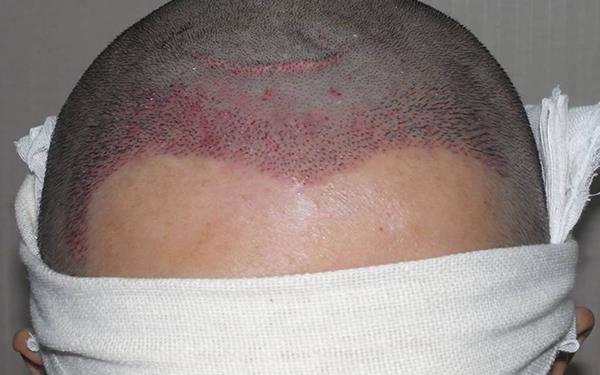 植發大概需多少錢