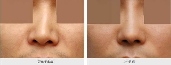 歪鼻整形手術前的注意事項有哪些