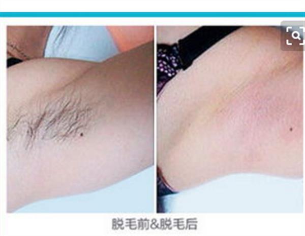 opt冰點<a href=http://www.f3bb6.cn/listinfo-670-0.html target=_blank class=infotextkey>脫毛</a>得危害