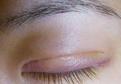 割完<a href=http://www.f3bb6.cn/listinfo-724-0.html target=_blank class=infotextkey>雙眼皮</a>多久能吃辣