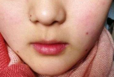 激光點痣后要注意什么