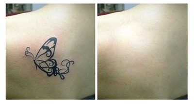 植皮<a href=http://www.f3bb6.cn/listinfo-793-0.html target=_blank class=infotextkey>洗紋身</a>一般多少錢