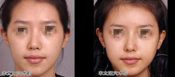 透明質酸<a href=http://www.f3bb6.cn/listinfo-630-0.html target=_blank class=infotextkey>豐太陽穴</a>一般能維持多久