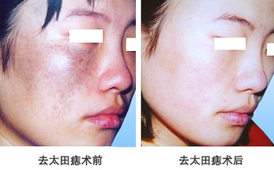 激光<a href=http://www.f3bb6.cn/listinfo-799-0.html target=_blank class=infotextkey>去太田痣</a>多少錢