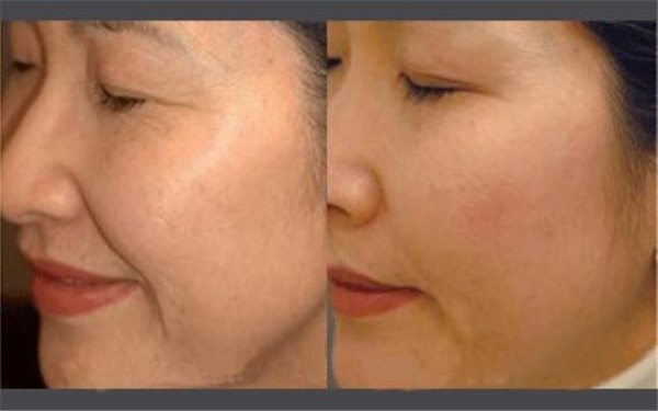 祛皺紋需要多少錢?