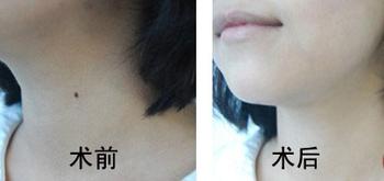 杭州哪家醫院<a href=http://www.f3bb6.cn/listinfo-767-0.html target=_blank class=infotextkey>祛痣</a>好