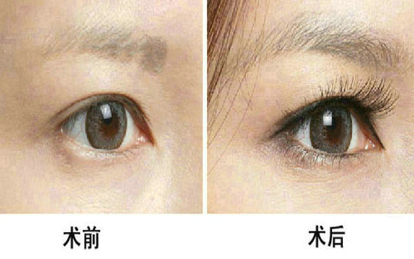 <a href=http://www.f3bb6.cn/listinfo-655-0.html target=_blank class=infotextkey>切眉</a>和提眉哪個效果好?