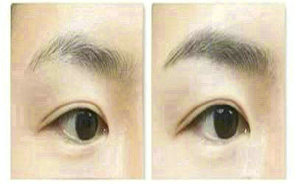 <a href=http://www.f3bb6.cn/listinfo-655-0.html target=_blank class=infotextkey>切眉</a>后多久恢復自然?