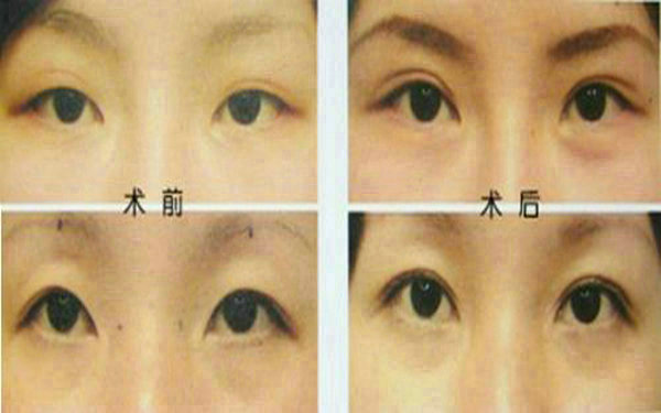 <a href=http://www.f3bb6.cn/listinfo-655-0.html target=_blank class=infotextkey>切眉</a>后多久可以<a href=http://www.f3bb6.cn/listinfo-657-0.html target=_blank class=infotextkey>繡眉</a>?