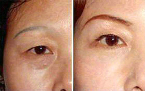 <a href=http://www.f3bb6.cn/listinfo-655-0.html target=_blank class=infotextkey>切眉</a>后多久能恢復?