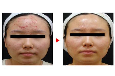 蕾特恩祛痘多少錢