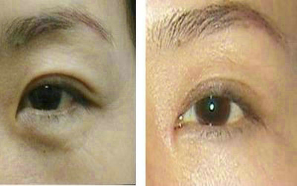 <a href=http://www.f3bb6.cn/listinfo-655-0.html target=_blank class=infotextkey>切眉</a>恢復期