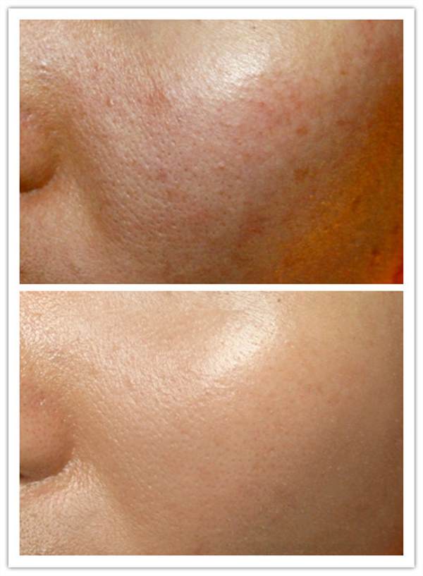 <a href=http://www.f3bb6.cn/listinfo-779-0.html target=_blank class=infotextkey>治療痤瘡</a>大概花多少錢