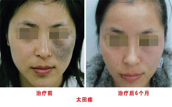 祛太田痣價(jià)格