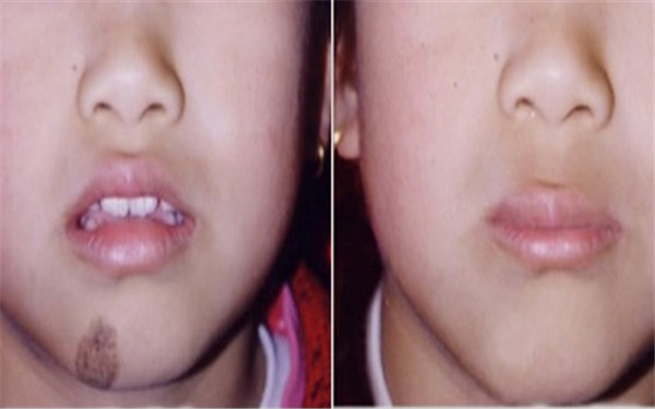 <a href=http://www.f3bb6.cn/listinfo-773-0.html target=_blank class=infotextkey>去胎記</a>的費用是多少