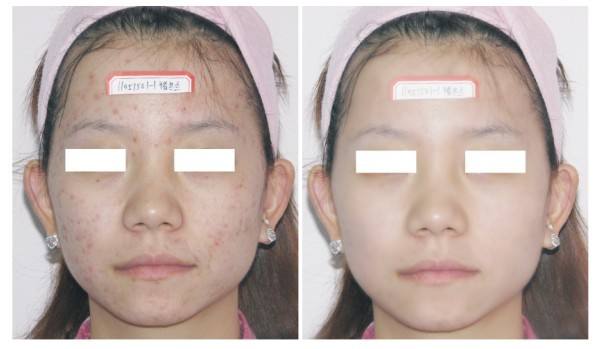 光子美白<a href=http://www.f3bb6.cn/listinfo-770-0.html target=_blank class=infotextkey>嫩膚</a>多少錢