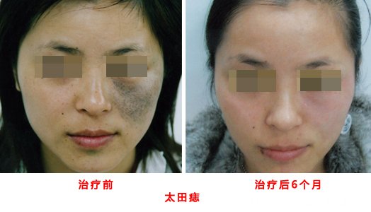 治療胎記太田痣多少錢