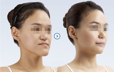 臉型矯正手術風險大嗎