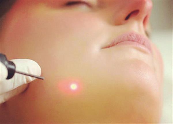 激光<a href=http://www.f3bb6.cn/listinfo-797-0.html target=_blank class=infotextkey>去痘疤</a>多久恢復(fù)