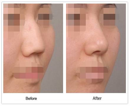 <a href=http://www.f3bb6.cn/listinfo-756-0.html target=_blank class=infotextkey>駝峰鼻矯正</a>后的注意事項